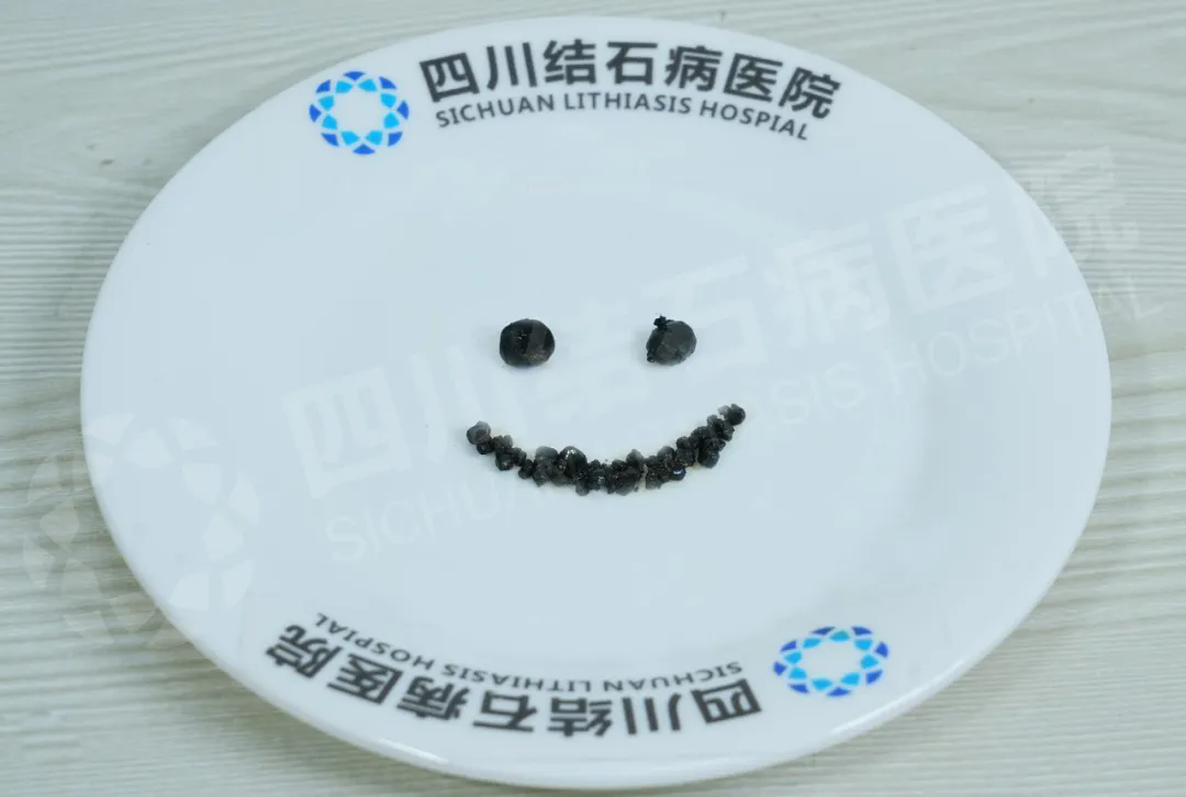 为什么肝内胆管有损伤更要保胆？这台手术，藏着一项复旦研究结论(图1)