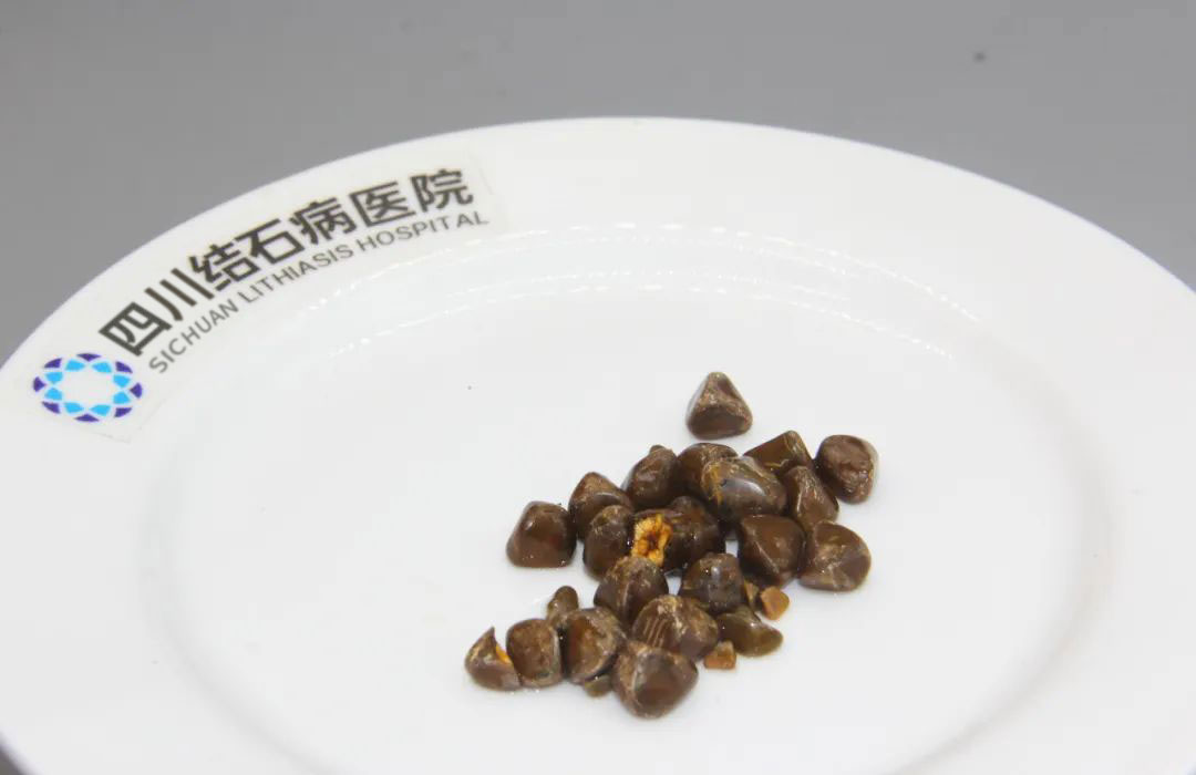查出胆囊结石,想保胆又怕复发?先看这个指标【成都只有一家结石专科】(图5) 查出胆囊结石,想保胆又怕复发?先看这个指标【成都只有一家结石专科】(图5)