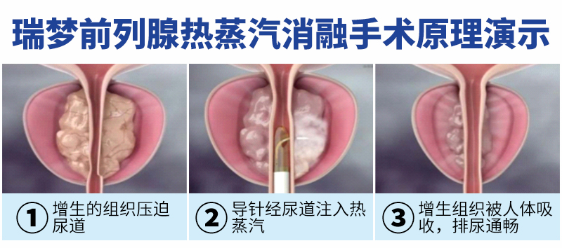中老年前列腺增生新选择！瑞梦热蒸汽消融，超微创保护功能(图2)