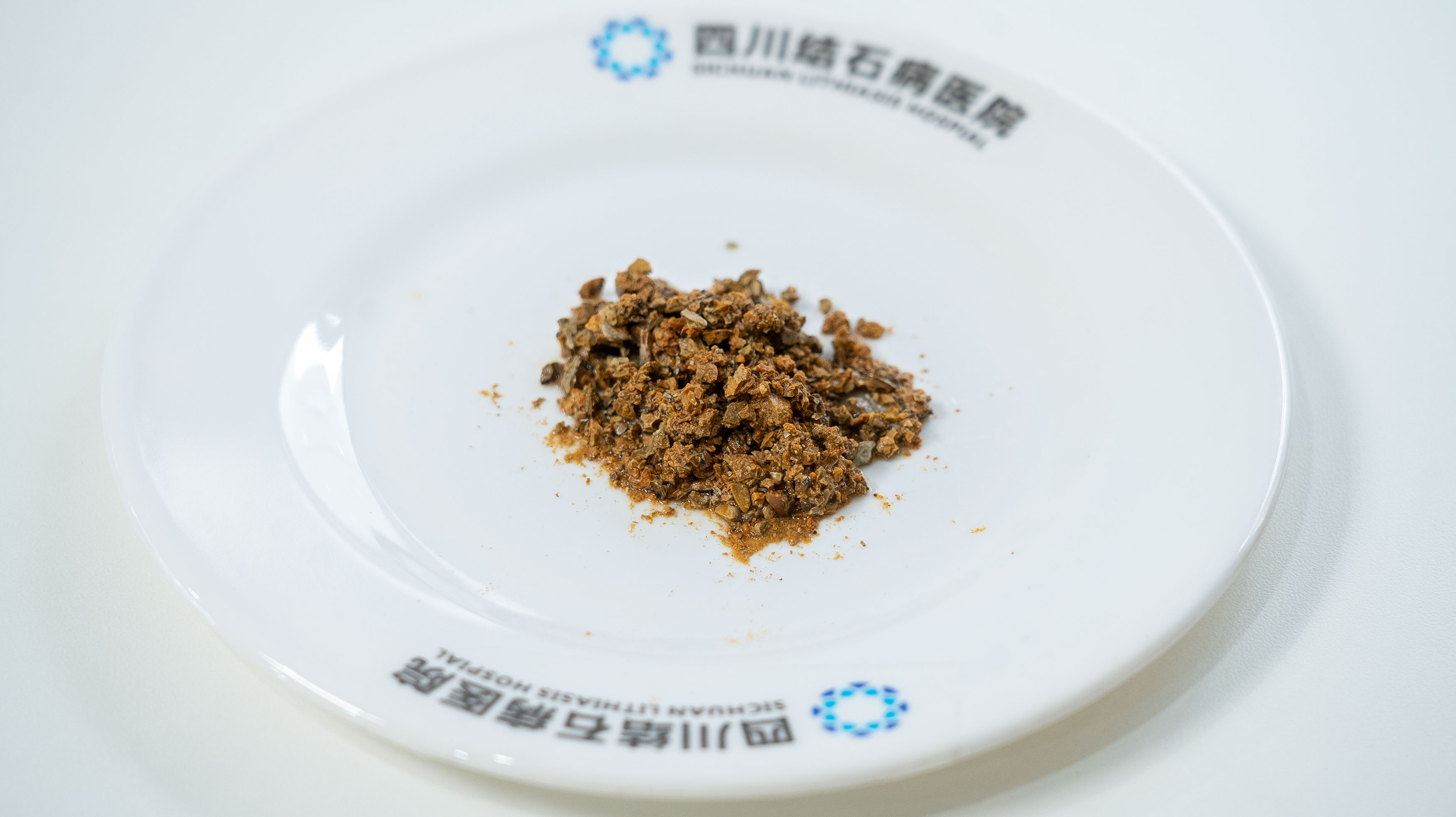 查出胆囊结石，想保胆又怕复发？先看这个指标【成都只有一家结石专科】(图5)
