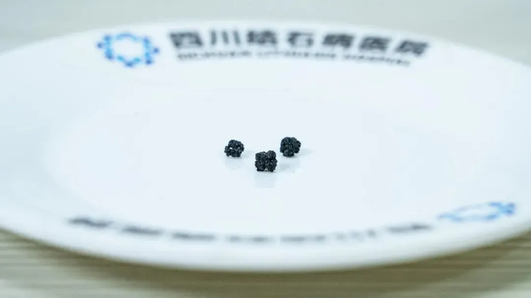 不吃早餐到底有多伤胆?成都27岁患者的真实经历值得警惕【成都只有一家结石专科】(图1) 不吃早餐到底有多伤胆?成都27岁患者的真实经历值得警惕【成都只有一家结石专科】(图1)