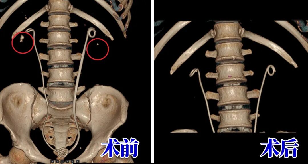 别被无症状结石骗了!姜先生亲身经历:小石头拖出大麻烦【四川肾结石医院】(图1) 别被无症状结石骗了!姜先生亲身经历:小石头拖出大麻烦【四川肾结石医院】(图1)