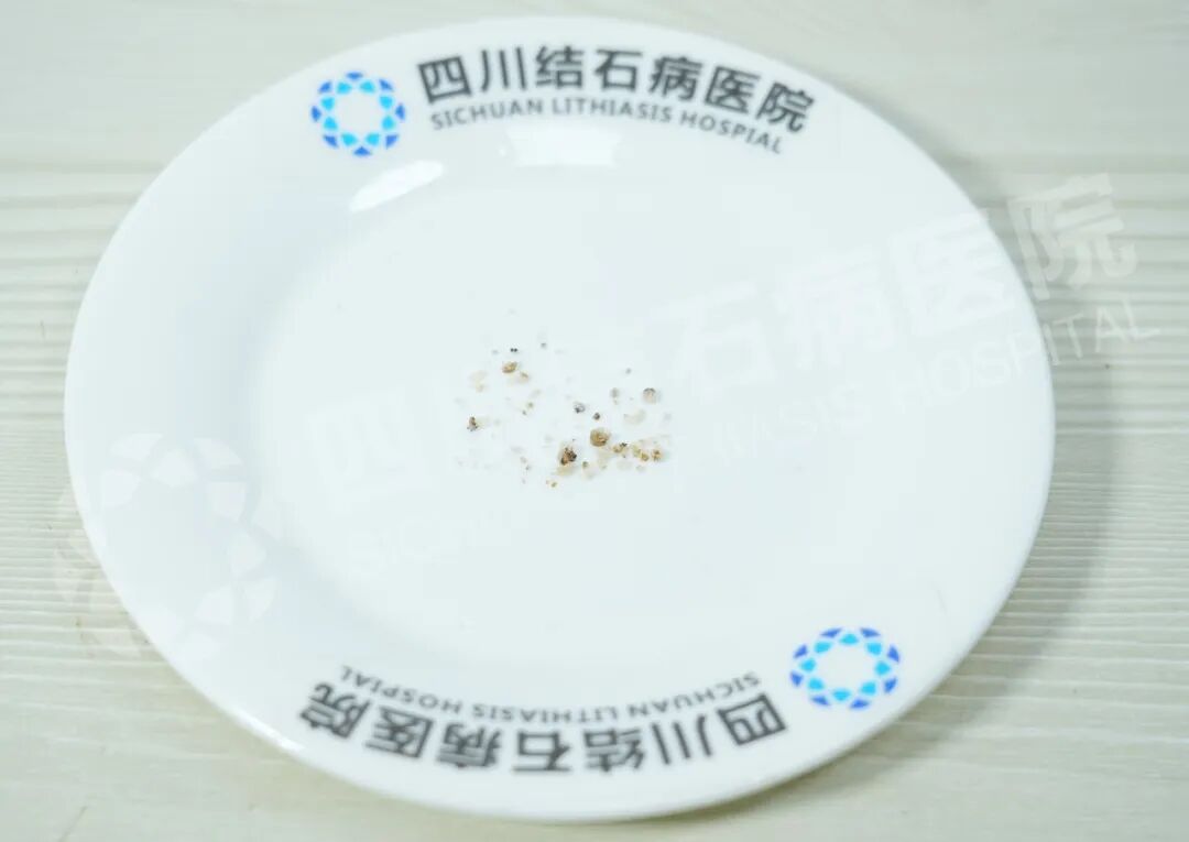 别被无症状结石骗了!姜先生亲身经历:小石头拖出大麻烦【四川肾结石医院】(图3) 别被无症状结石骗了!姜先生亲身经历:小石头拖出大麻烦【四川肾结石医院】(图3)