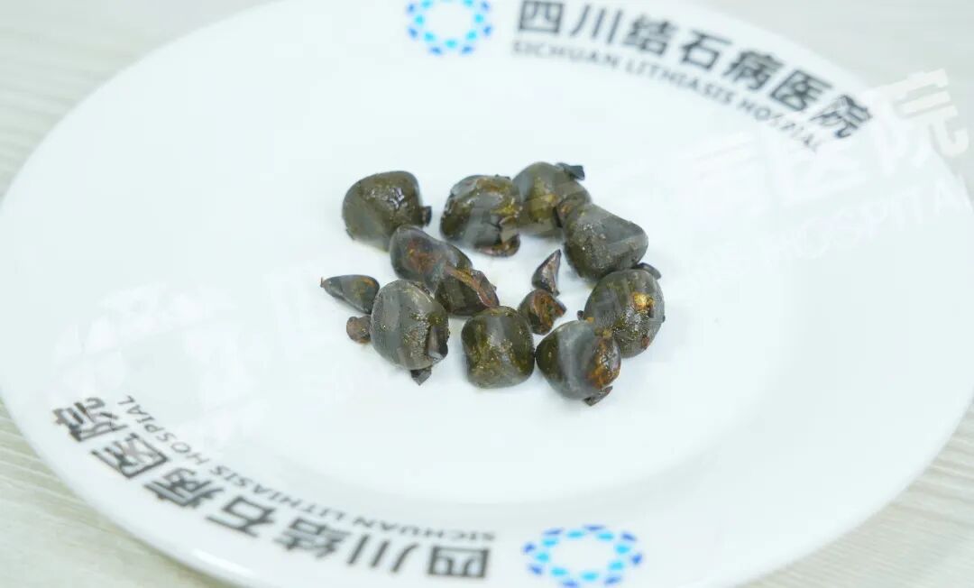 保胆取石选哪里？他们用“推荐亲友”投了票【四川结石病医院】(图2)