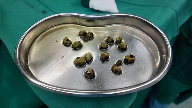 无症状胆囊结石别忽视！结石持续增大，尽早评估还有机会保胆【四川结石病医院】(图2)